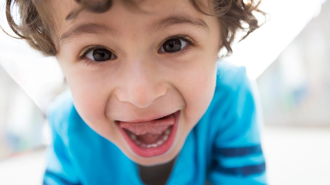 Frenectomy Photo